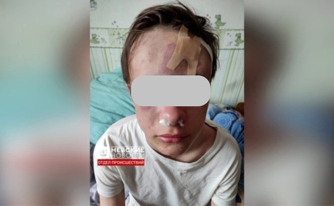 Избитого в Московском районе школьника будут ждать несколько месяцев реабилитации